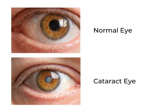 cataract